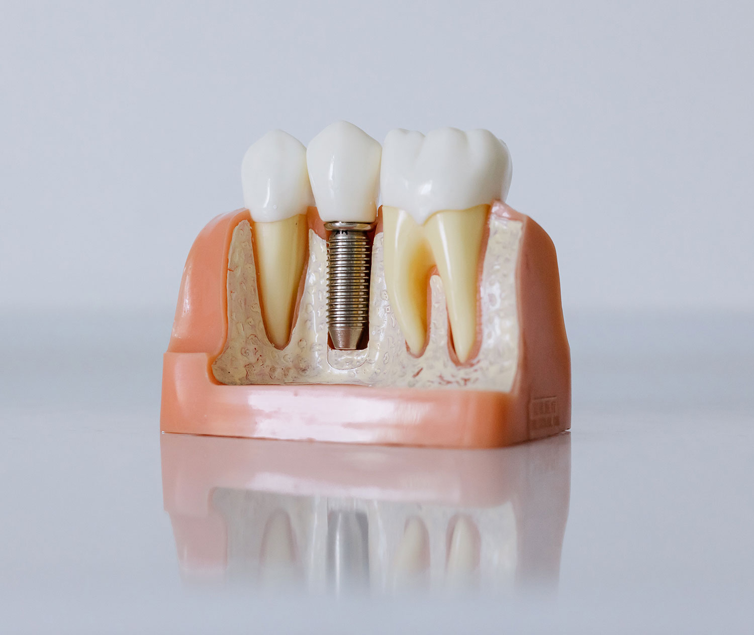 Clinica-Dental-Fernandez-Pineda-y-Gonzalez-Gelves-Sevilla-implantes-dentales